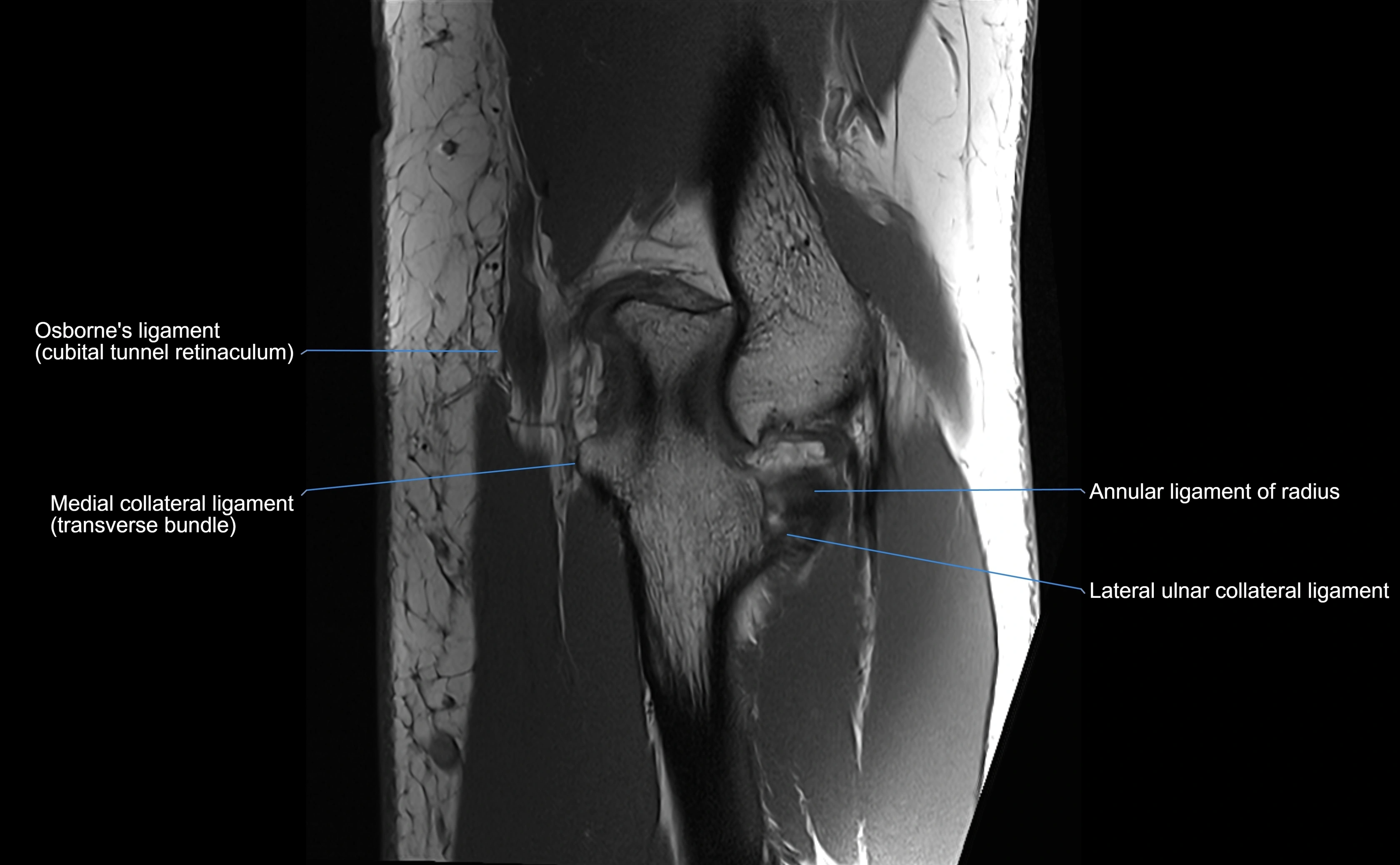 MRI elbow ligaments coronal cross sectional anatomy 3T  radiology  image-img-07001-00024.webp